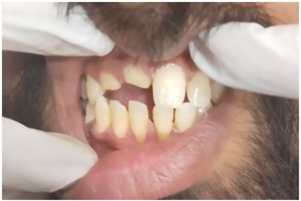 Front_teeth_damage