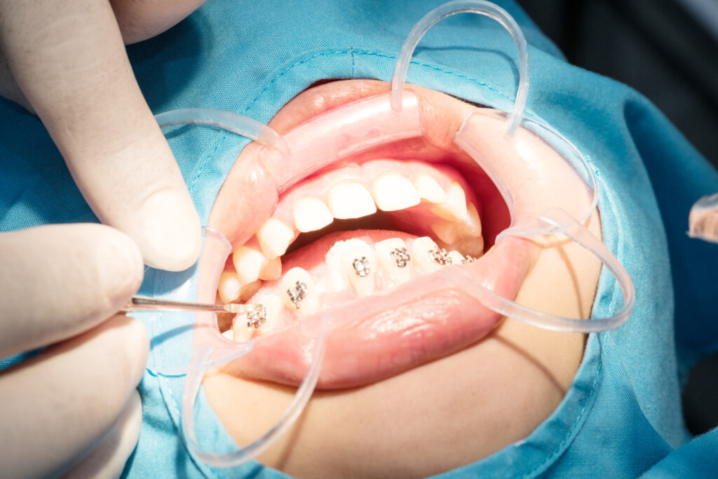 Orthodontic Treatment Process