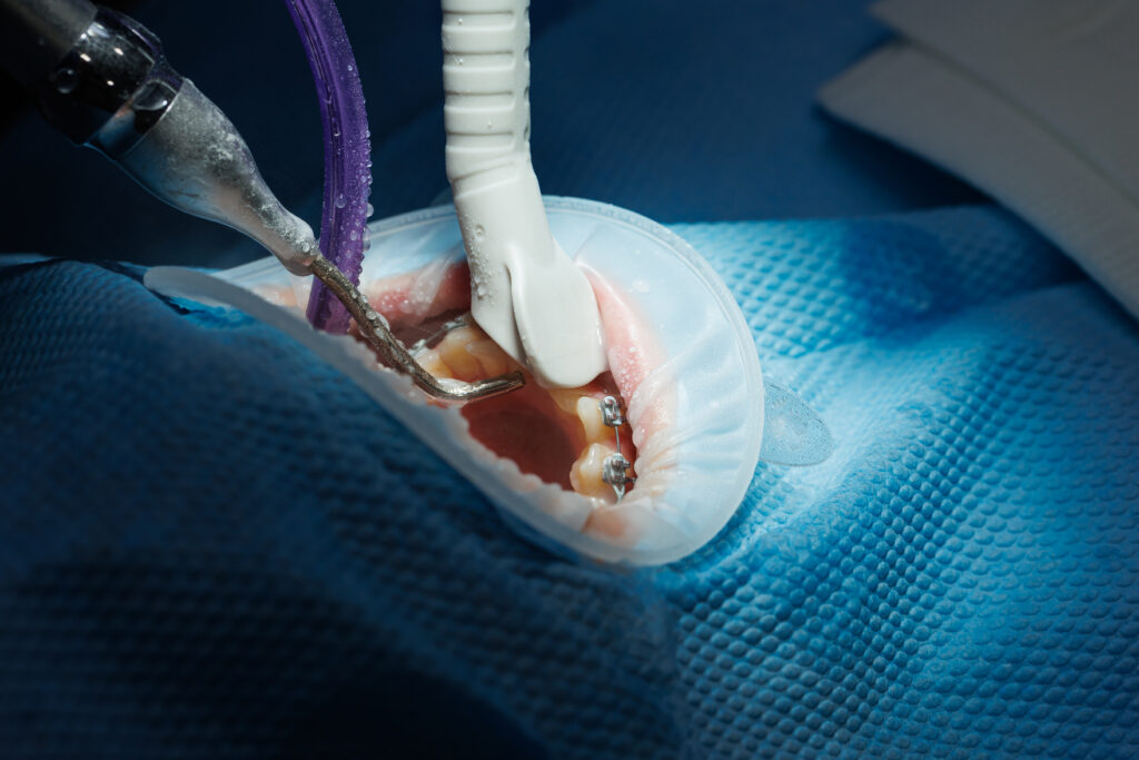 Implant Placement Surgery